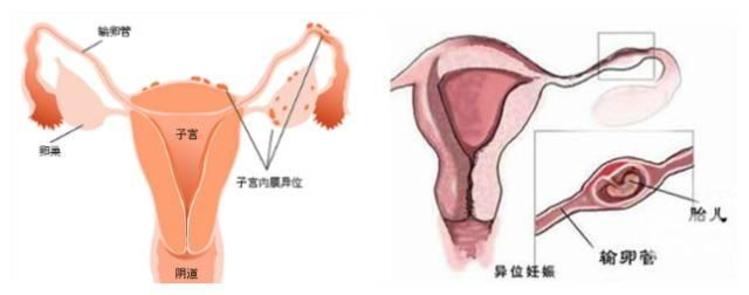 初产妇