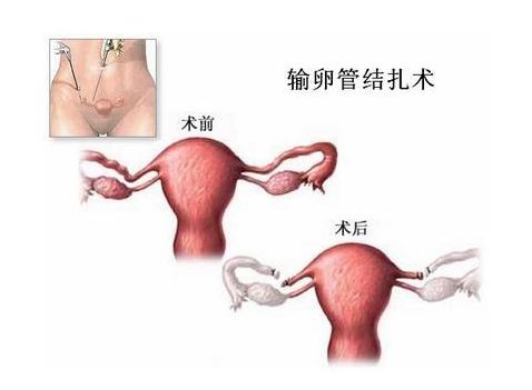 刚怀孕出血