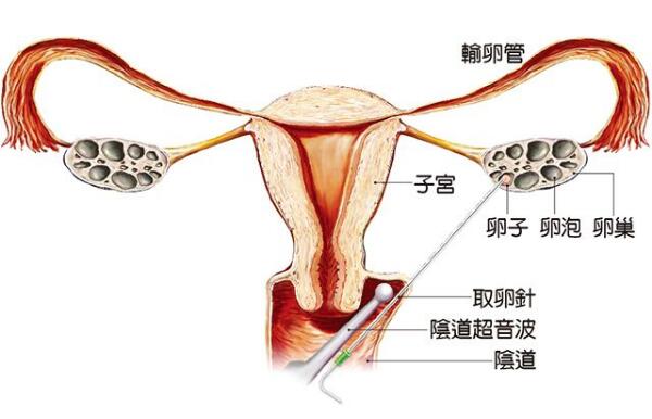 嘉兴试管捐卵助孕
